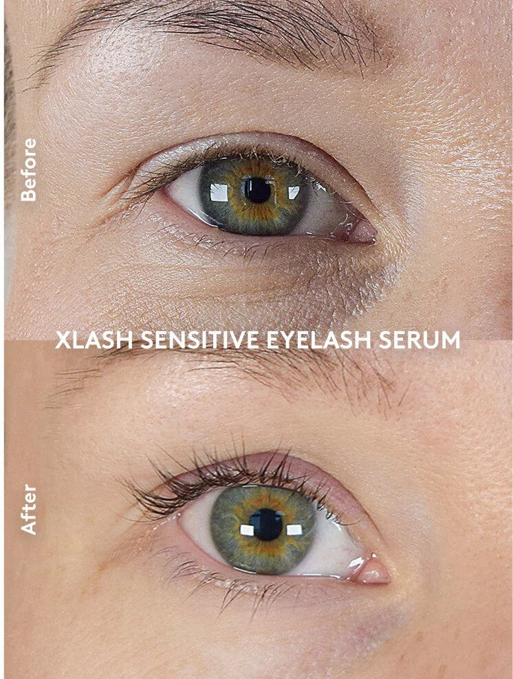 Prikaz rezultata korištenja Xlash Sensitive seruma